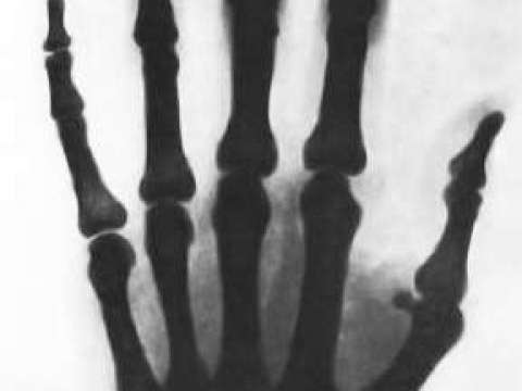 X-ray Tesla took of his hand