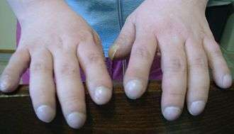 Clubbing of fingers in a patient with Eisenmenger's syndrome; first described by Hippocrates, clubbing is also known as 