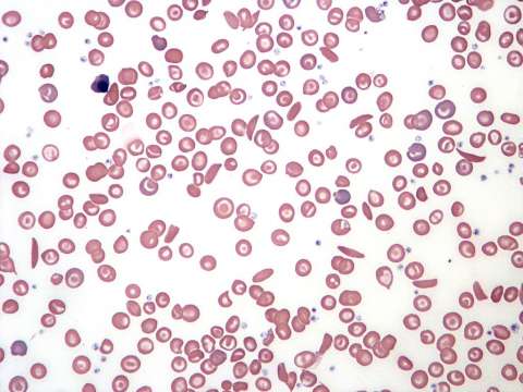 Blood smear illustrating sickle cell anaemia.