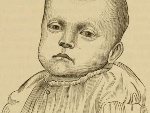 Head of a rachitic child in the New York Infant Asylum (1895)