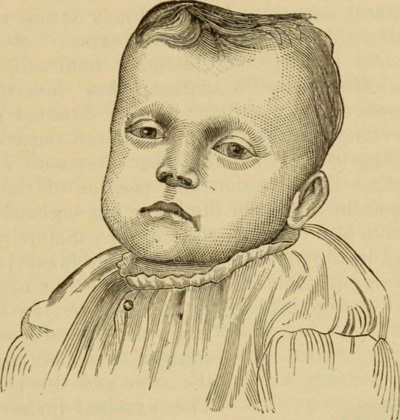 Head of a rachitic child in the New York Infant Asylum (1895)