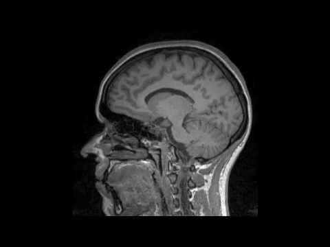 Brain Awareness Video Contest: Penfield, Epilepsy and the Functional Brain