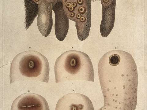 Jenner's discovery of the link between cowpox pus and smallpox in humans helped him to create the smallpox vaccine.